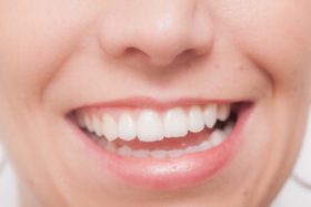 白い歯になりたい！家で簡単にホワイトニングは可能？